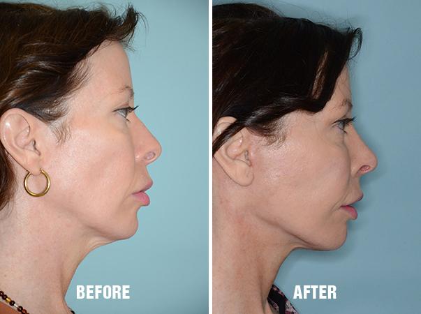 Necklift Before and After Photos in Miami, FL, Patient 2588