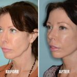 Necklift Before and After Photos in Miami, FL, Patient 2588