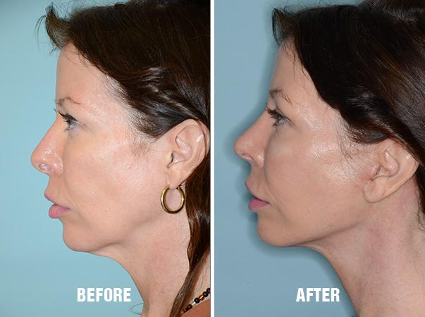 Necklift Before and After Photos in Miami, FL, Patient 2588