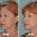 Necklift Before and After Photos in Miami, FL, Patient 2534