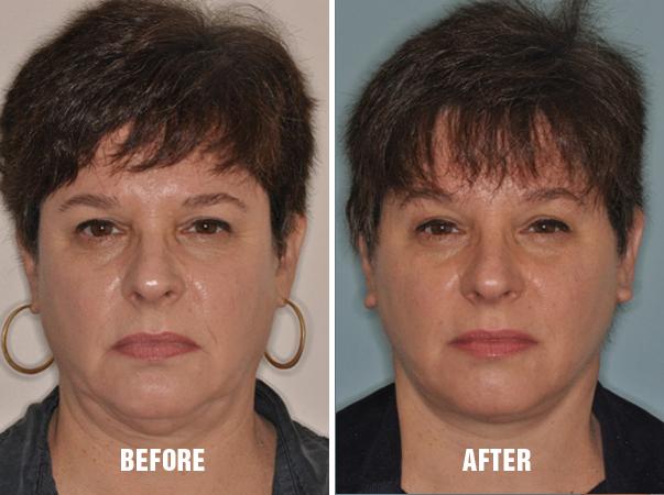 Necklift Before and After Photos in Miami, FL, Patient 2786