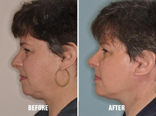 Necklift Before and After Photos in Miami, FL, Patient 2786