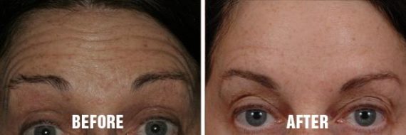 Non Surgical Before and After Photos in Miami, FL, Patient 2657