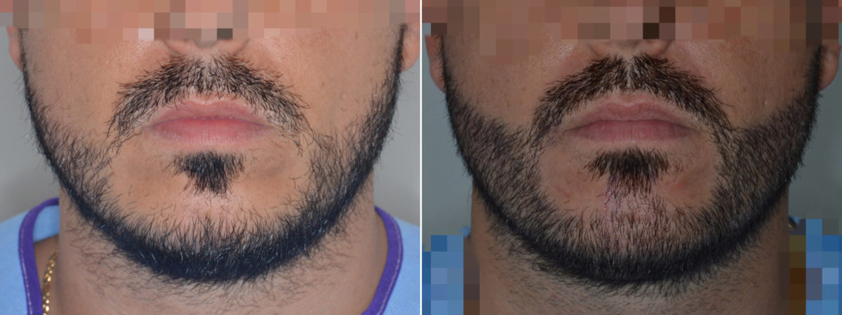 Hair Restoration Before and After Photos in Miami, FL, Patient 3086