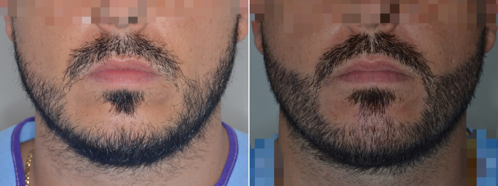 Beard Transplants | Miami, FL | Dr. Anthony Bared