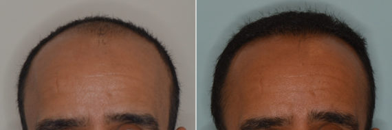 Hair Transplant Before and After Photos in Miami, FL, Patient 3112