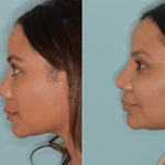 Rhinoplasty Before and After Photos in Miami, FL, Patient 3235