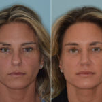 Rhinoplasty Before and After Photos in Miami, FL, Patient 3333