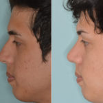 Rhinoplasty Before and After Photos in Miami, FL, Patient 3444