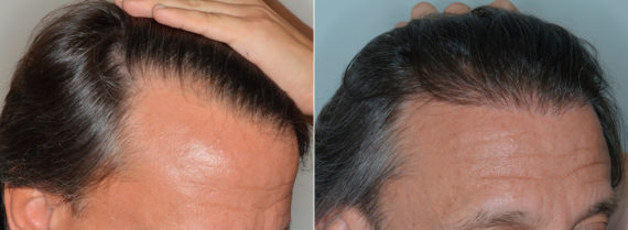 Hair Transplant Before and After Photos in Miami, FL, Patient 3508