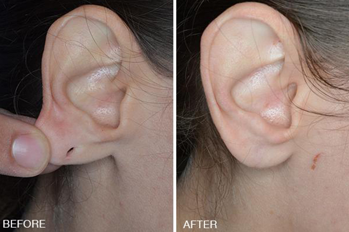 Say Goodbye to Stretched and Ripped Earlobes with Earlobe Repair