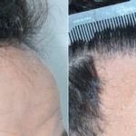 Hair Transplant Before and After Photos in Miami, FL, Patient 3841