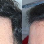 Hair Transplant Before and After Photos in Miami, FL, Patient 3841