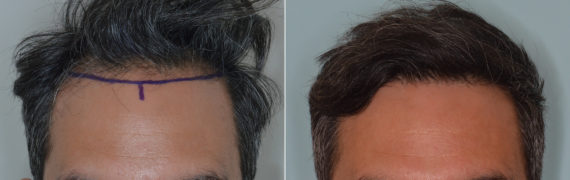 Hair Transplant Before and After Photos in Miami, FL, Patient 4178