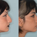 Rhinoplasty Before and After Photos in Miami, FL, Patient 4318