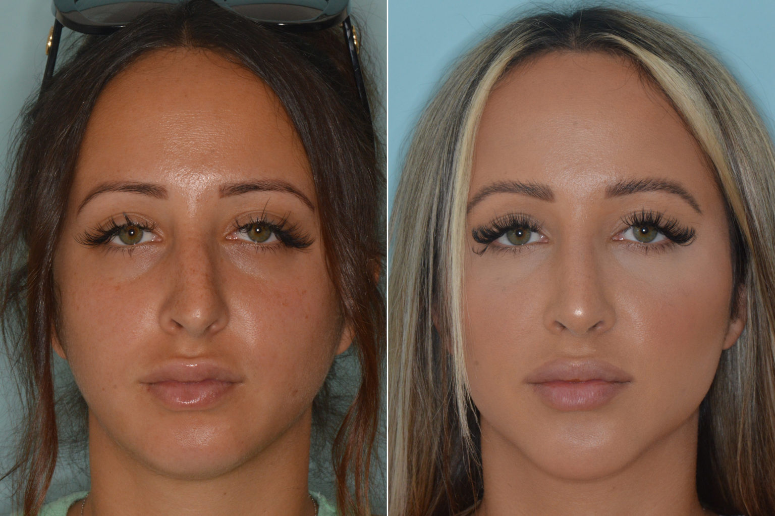 fixing-a-crooked-nose-with-rhinoplasty-miami-fl