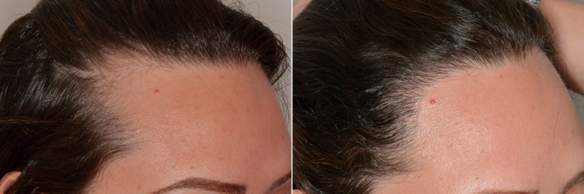 Hair Restoration Before and After Photos in Miami, FL, Patient 4486