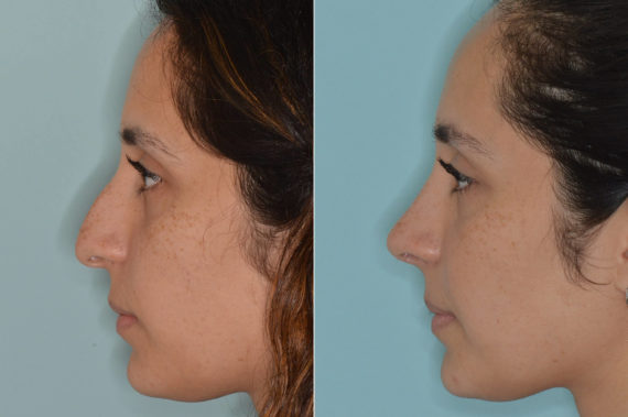 Rhinoplasty Before and After Photos in Miami, FL, Patient 4611