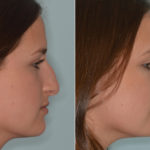 Rhinoplasty Before and After Photos in Miami, FL, Patient 4633