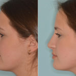 Rhinoplasty Before and After Photos in Miami, FL, Patient 4633