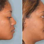 Ethnic Rhinoplasty Before and After Photos in Miami, FL, Patient 1004