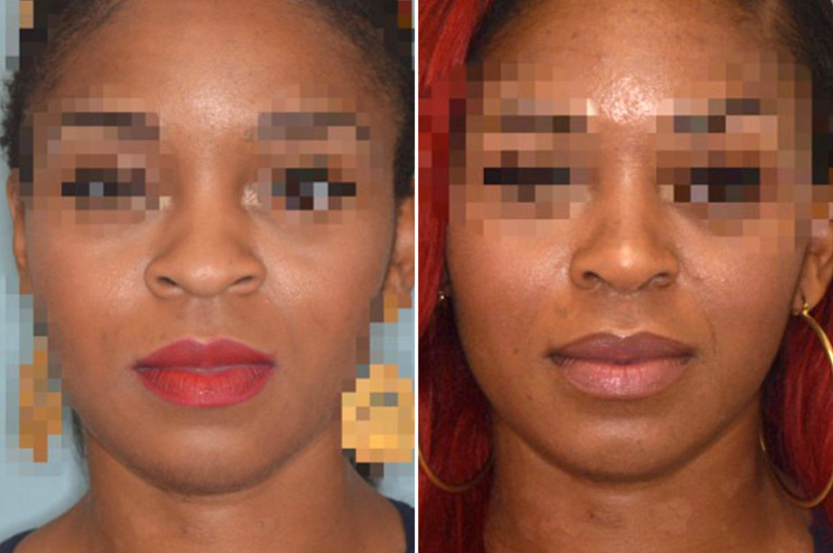 Ethnic Rhinoplasty Before and After Photos in Miami, FL, Patient 1035