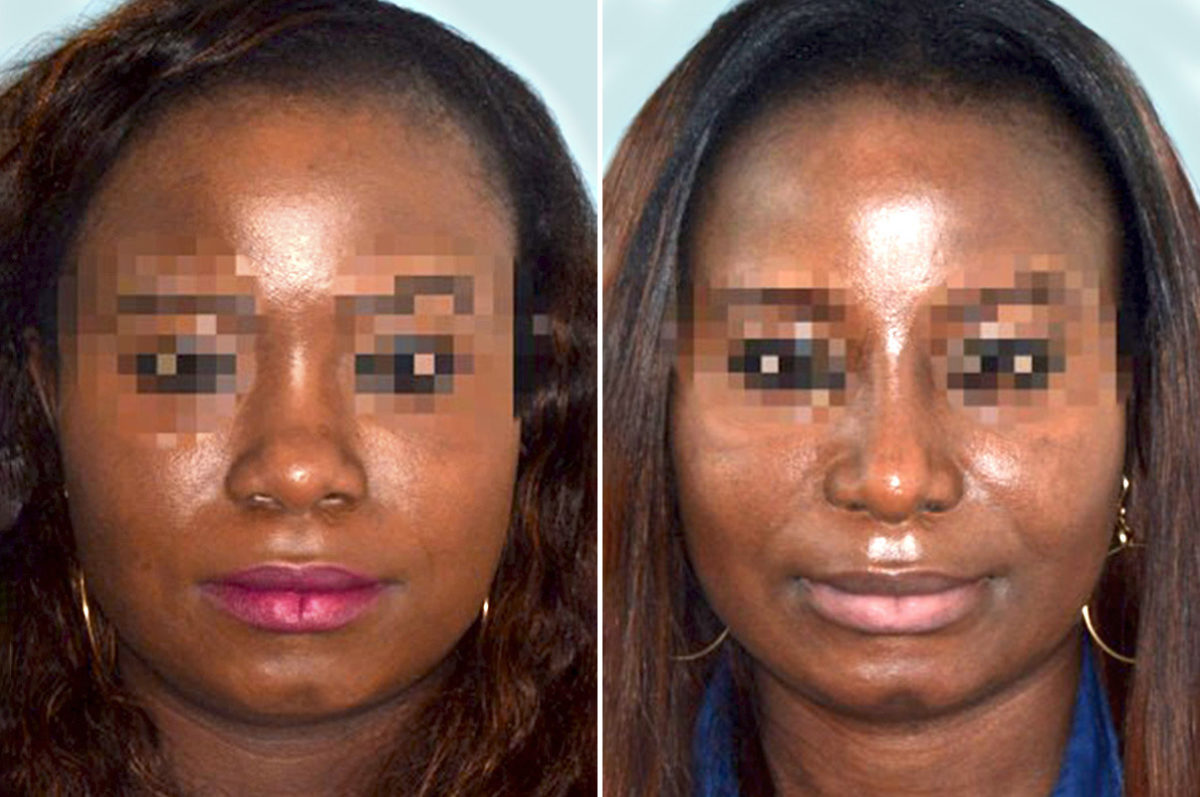 Ethnic Rhinoplasty Before and After Photos in Miami, FL, Patient 1056