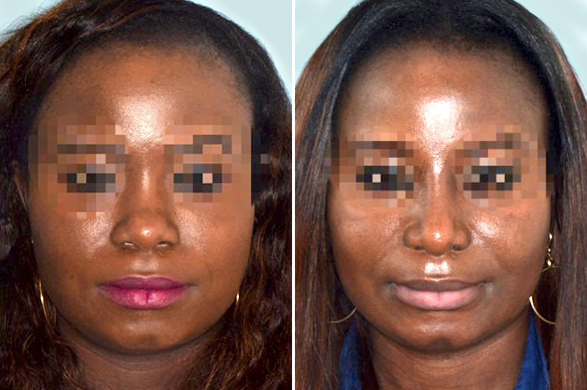 Ethnic Rhinoplasty Photos Miami Facial Plastic Surgery 