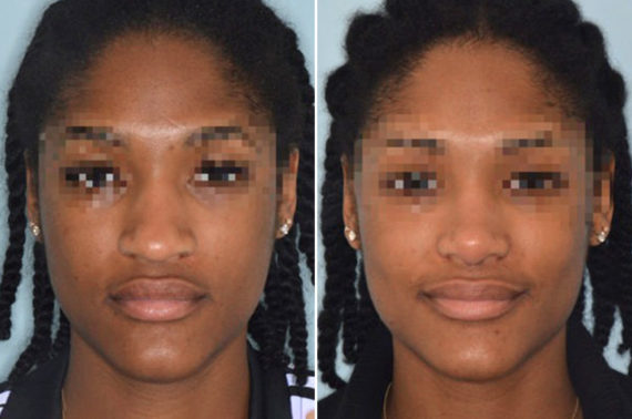 Ethnic Rhinoplasty Photos Miami Facial Plastic Surgery 