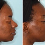 Ethnic Rhinoplasty Before and After Photos in Miami, FL, Patient 3773