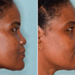 Ethnic Rhinoplasty Before and After Photos in Miami, FL, Patient 4612