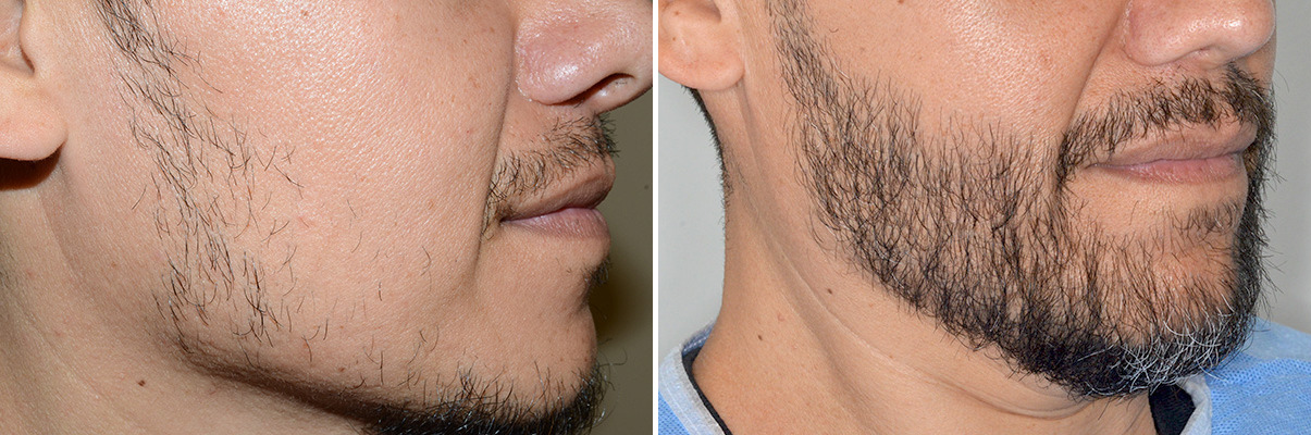 Beard Transplant Photos Miami Fl Patient 6392