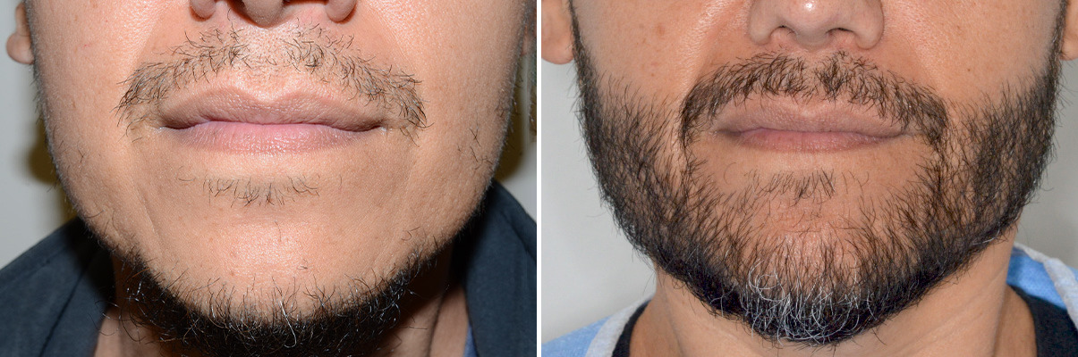 Beard Transplant Photos - Dr. Anthony Bared, M.D - Facial Plastic Surgeon