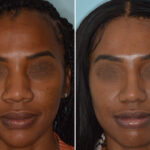 Ethnic Rhinoplasty Before and After Photos in Miami, FL, Patient 6454