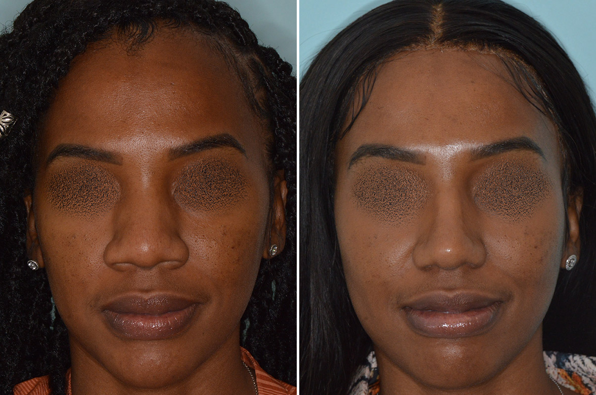 Ethnic Rhinoplasty Photos Dr Anthony Bared Md Facial Plastic Surgeon 