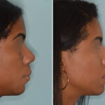 Ethnic Rhinoplasty Before and After Photos in Miami, FL, Patient 6485