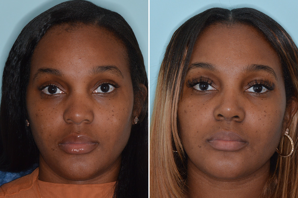 Ethnic Rhinoplasty Photos Miami Fl Patient 4612 