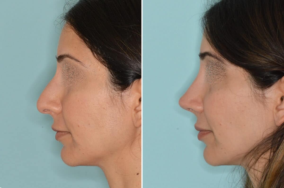 Rhinoplasty Before and After Photos in Miami, FL, Patient 6592