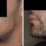 Beard Transplant Before and After Photos in Miami, FL, Patient 2721