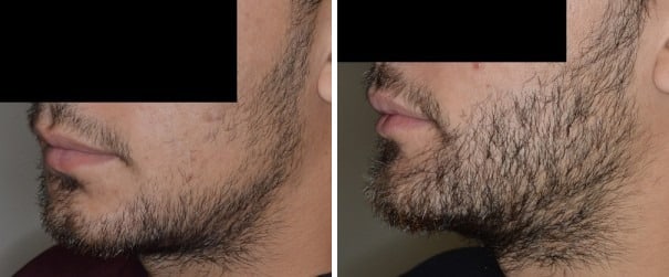 Beard Transplant Before and After Photos in Miami, FL, Patient 2721