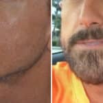 Beard Transplant Before and After Photos in Miami, FL, Patient 2776