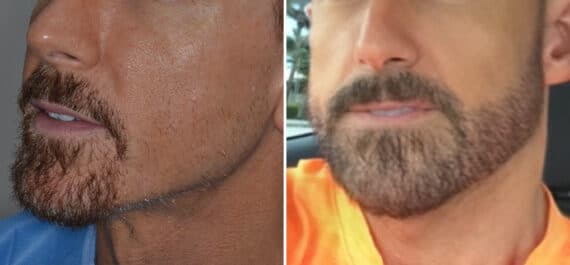 Beard Transplant Before and After Photos in Miami, FL, Patient 2776