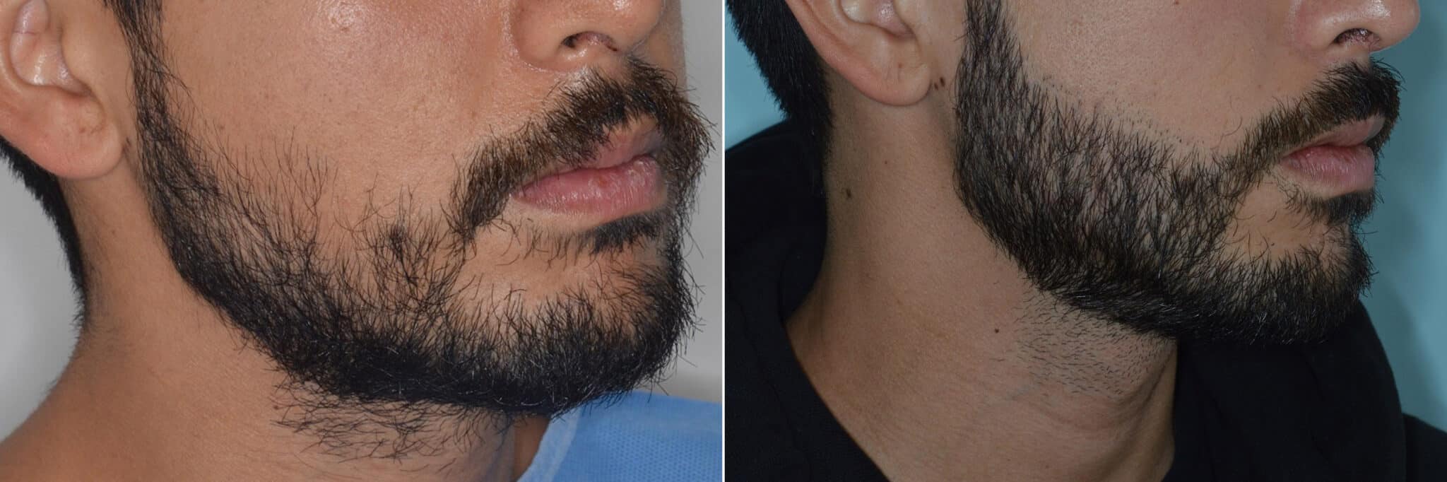 Beard Transplant Photos | Miami, FL | Patient 3272