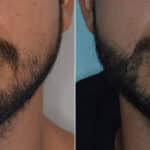 Beard Transplant Before and After Photos in Miami, FL, Patient 3272