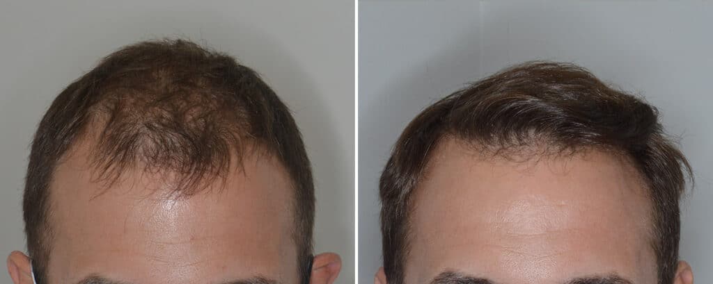 Hair Transplant Photos - Dr. Anthony Bared, M.d - Facial Plastic Surgeon