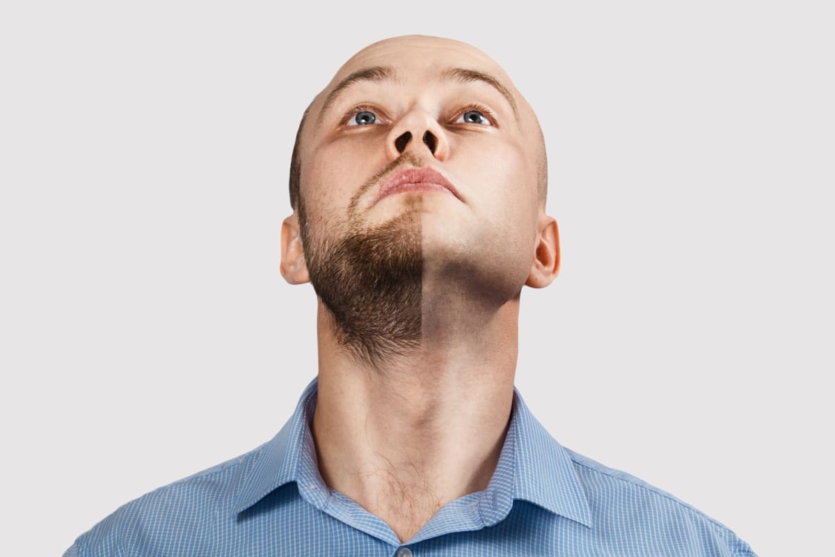 Close-up of a man looking up, contemplating a beard transplant for a fuller facial hair appearance.