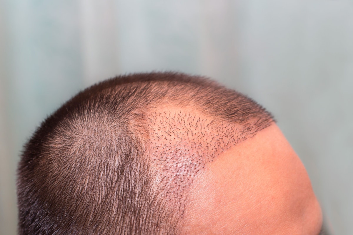 The hair growth process involves unique dynamics specific to each individual's hair situation.