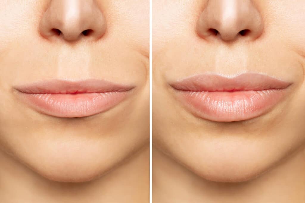 Before and after a Volbella treatment for the lips.