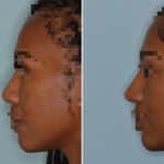 Ethnic Rhinoplasty Before and After Photos in Miami, FL, Patient 7085