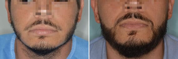 Beard Transplant Before and After Photos in Miami, FL, Patient 7491